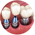 implantes dentales al mejor precio