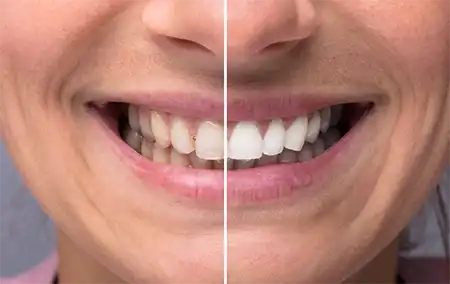 blanqueamiento dental antes y despues