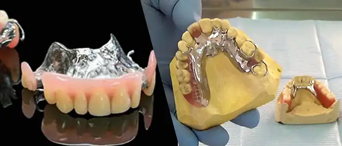 protesis dentales metalicas